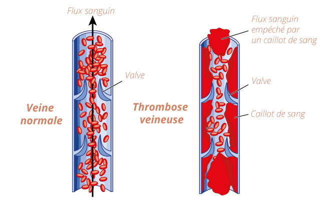 schema-phlebite-thrombose-veineuse-2