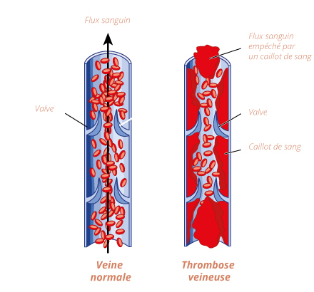 schema-phlebite-thrombose-veineuse-3