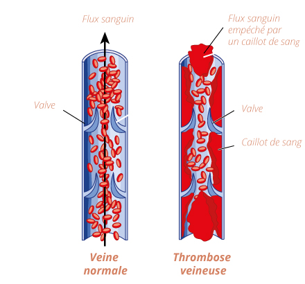 schema-phlebite-thrombose-veineuse-4