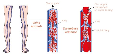 schema-phlebite