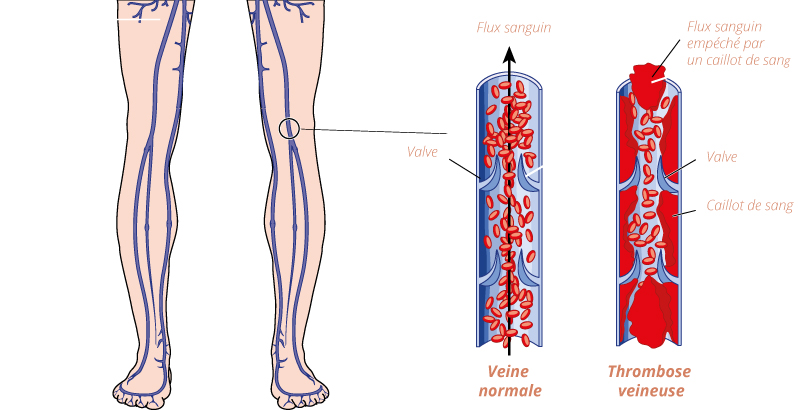 trombeuse-veineuse