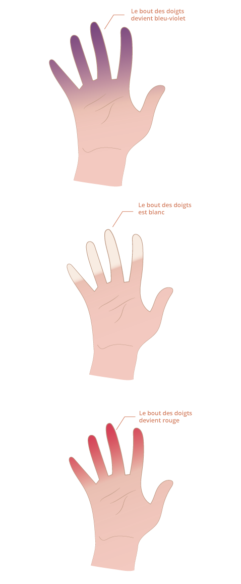 syndrome_raynaud