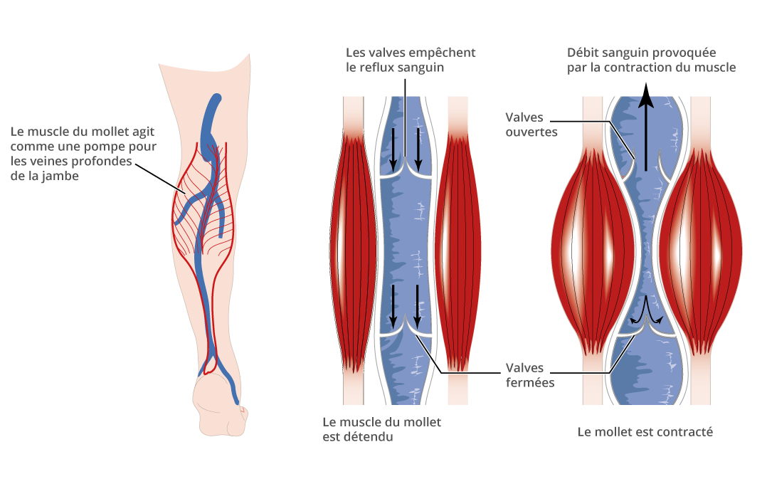 pompe-musculaire-varices